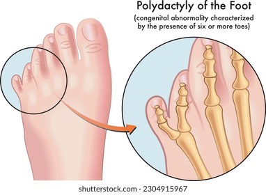 Ilustración médica de un pie afligido con polidáctilo, una anormalidad congénita caracterizada por la presencia de seis o más dedos de pie, con anotaciones.