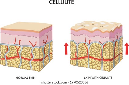 Medical illustration of the formation of cellulite.