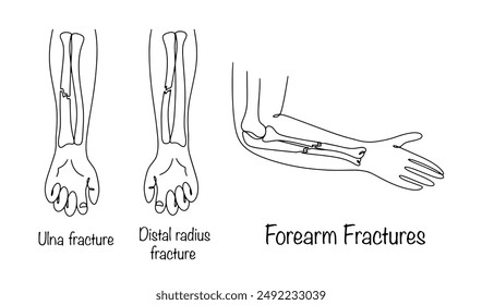 Ilustración médica con una fractura de cúbito, radio y ambos huesos al mismo tiempo. Consecuencia de graves lesiones en la mano. Vector aislado sobre fondo blanco.