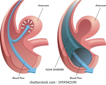 Medical illustration of the function of the flow diverter.
