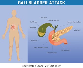 Ilustração médica do ataque da vesícula biliar com anatomia rotulada incluindo cálculos biliares, dutos biliares, pâncreas e órgãos do sistema digestivo.

