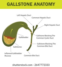 Ilustração médica da anatomia do cálculo biliar mostrando a vesícula biliar, os dutos biliares e os bloqueios de cálculos biliares com partes rotuladas. Diagrama anatômico de pedra biliar com dutos rotulados.

