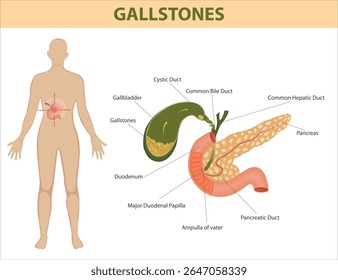Medical illustration of gallstones in the gallbladder and their anatomical relation to liver, pancreas, ducts, and duodenum. Medical illustration of gallstones in the body.

