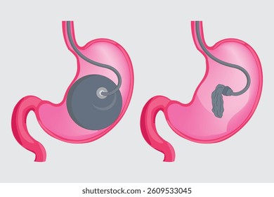 medical illustration. Gastric balloon insertion and deflation process in stomach for weight loss treatment. eps 10