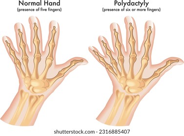 Medizinische Illustration einer Hand, die mit Polydactyly, einer angeborenen Anomalie, die durch das Vorhandensein von sechs oder mehr Fingern gekennzeichnet ist.