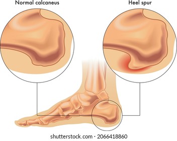 Medical illustration of heel spur, an abnormal growth of the heel bone.