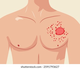 Medical illustration of a human chest with a skin rash, redness, and inflammation. Symptoms of skin infection, allergic reaction, or dermatological disease