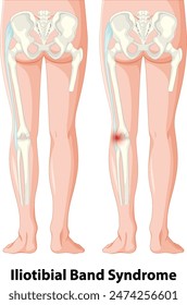 Medical illustration of iliotibial band syndrome