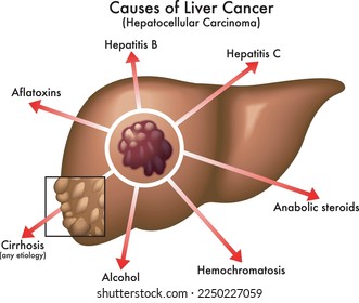 Medizinische Veranschaulichung der Hauptursachen von Leberkrebs mit Anmerkungen auf weißem Hintergrund.