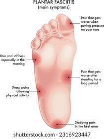 Medizinische Veranschaulichung der Hauptsymptome der Plantarfasciitis, mit Anmerkungen.