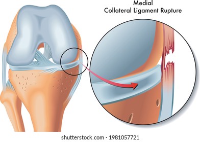 Medical Illustration of medial collateral ligament rupture.