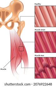 Medical illustration of muscle strain and tear injury.