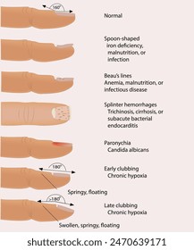 Medical illustration. Nail disease.informational poster for podiatrists. Nail diseases. Medicine and cosmetology. Vector illustration
