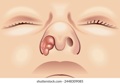 Medical illustration of a nasal tumor.