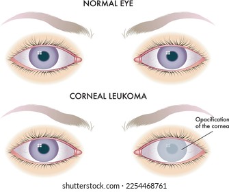 Medical illustration of one of the possible consequences of corneal leukoma on the eye.