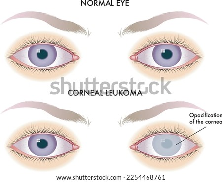 Medical illustration of one of the possible consequences of corneal leukoma on the eye.