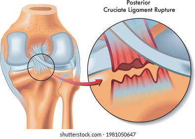 Medical Illustration of posterior cruciate ligament rupture.