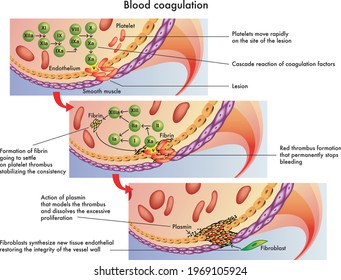 Medical Illustration Of The Process Of Blood Coagulation, With Annotations.