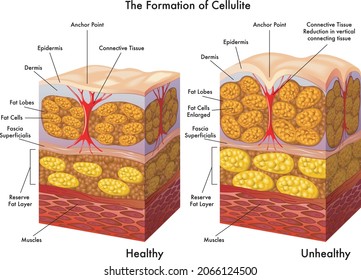 Medical illustration of the process of formation of cellulite.