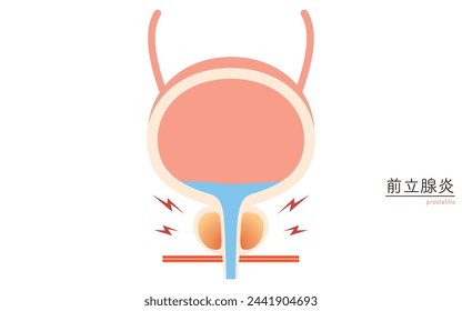 Ilustración médica de próstata, prostatitis, ilustración vectorial