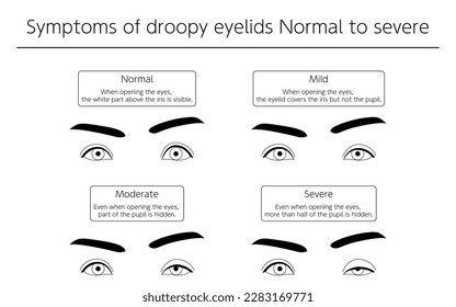 Ilustración médica, síntomas de ptosis normales a graves - Traducción: Al abrir los ojos, se ve la parte blanca por encima del iris. Al abrir los ojos, el párpado cubre el iris pero no el cachorro