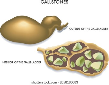 Medical illustration of the section of the gallbladder with gallstones.