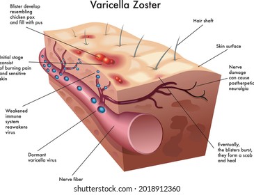 Medical illustration of a section of skin affected by varicella zoster virus, with annotations.