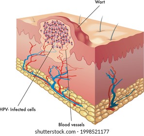 Medical illustration of a section of a wart.