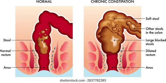 Medical illustration showing the difference between a normally functioning colon and one afflicted by chronic constipation, with annotations.