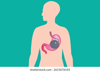 Medical illustration showing an intragastric balloon inside the human stomach, placed within a human body silhouette on a teal background. This diagram is used to represent a weight loss procedure