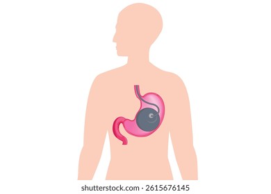 Medical illustration showing an intragastric balloon inside the human stomach, placed within a human body silhouette on a teal background. This diagram is used to represent a weight loss procedure