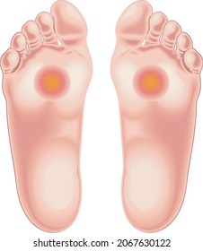 Ilustración médica que muestra partes de los pies afligidos por el dolor de metatarsalgia.