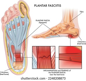 Medical illustration showing section of foot with symptoms of plantar fasciitis with two magnified details of affected points, and annotations