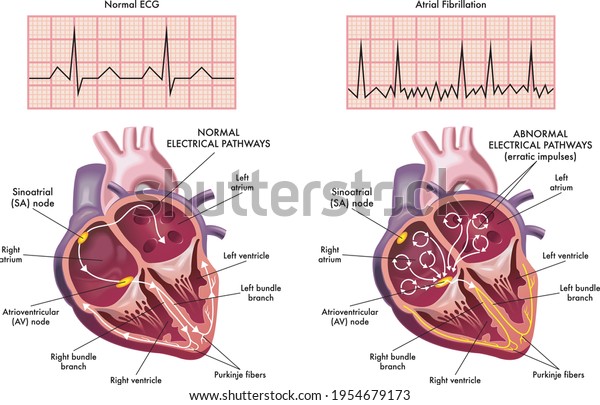 Medical illustration\
showing the symptoms of a heart with atrial fibrillation compared\
to normal one.