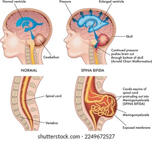 Medical illustration shows a child in two situations, left healthy and right afflicted by spina bifida with annotations explaining the symptoms of the pathology.