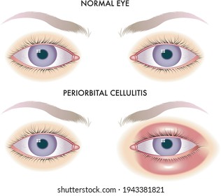 Medical Illustration Shows The Comparison Between Normal Eyes And Those Affected By Periorbital Cellulitis. 