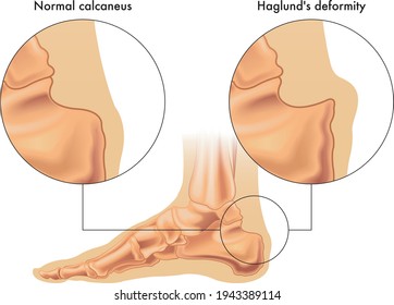 Medical illustration shows the comparison between a normal calcaneus and one affected by Haglund's deformity, with annotations.