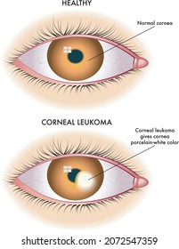 Medical illustration shows the comparison between a normal eye and one affected by corneal leukoma.