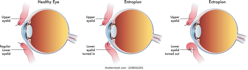 La ilustración médica muestra la comparación entre un ojo normal, uno afectado por entropión y otro afectado por ectropión.