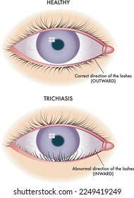 Medical illustration shows the comparison between a normal eye and one affected by trichiasis.