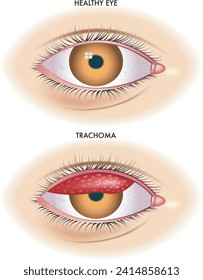 Medical illustration shows the comparison between a normal eye and one affected by trachoma an infectious disease caused by bacterium Chlamydia  trachomatis.