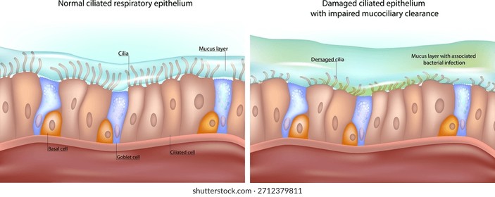 La ilustración médica muestra una comparación entre el epitelio respiratorio ciliado normal y el epitelio dañado con alteración del aclaramiento mucociliar. Epitelio Ciliado Versus Deterioro Saludable 