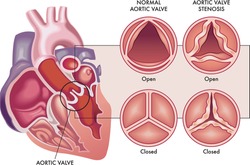 Medical Illustration Shows The Difference Between A Normal Aortic Valve And One With Stenosis, Open And Closed, And Its Location In The Heart, With Annotations.