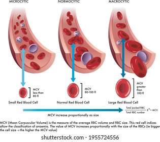 Medical Illustration Shows The Difference Between A Normal Red Blood Cell With One Afflicted From Microcytosis And Another From Macrocytosis, With Annotations.