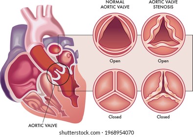 Medical illustration shows the difference between a normal aortic valve and one with stenosis, open and closed, and its location in the heart, with annotations.