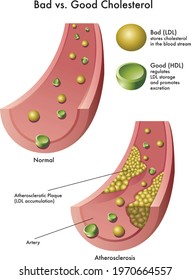 Medical illustration shows the difference between good cholesterol and bad cholesterol, with annotations. 