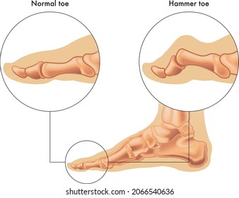 A medical illustration shows the difference between a normal toe and a hammer toe with annotations.  