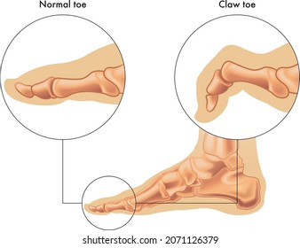 Medical illustration shows the difference between a normal toe and a claw toe, with annotations.