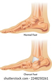 La ilustración médica muestra la diferencia entre un pie normal y un pie caracter.
