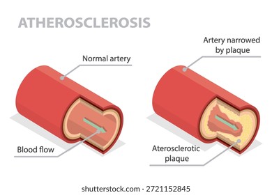 Die medizinische Abbildung zeigt den Unterschied zwischen einer normalen Arterie und einer Arteriosklerose. Mit einem isometrischen Bildungs-Flatbanner gekennzeichnet.